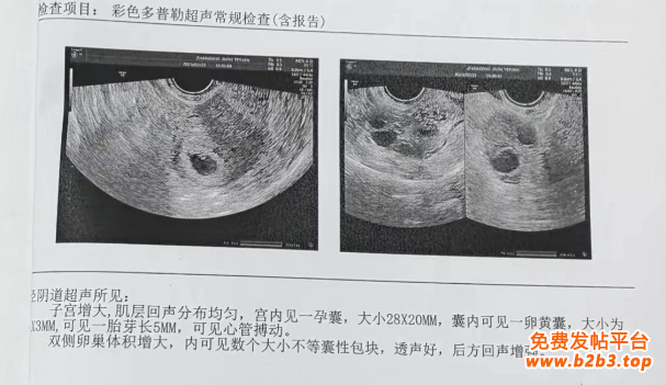 卵黄囊